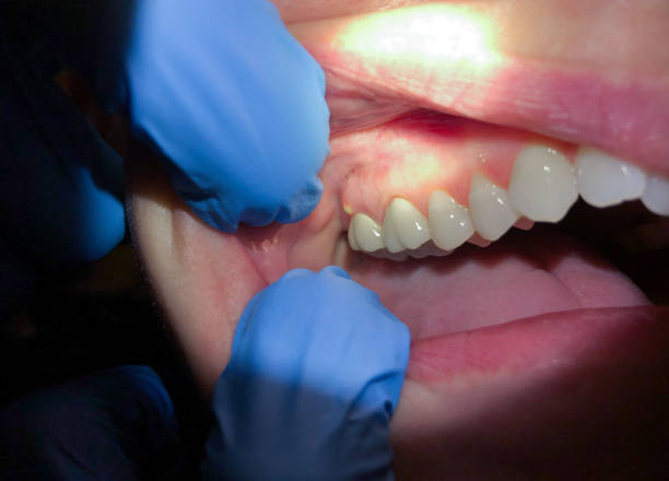 Best Urgent Care for Lost Fillings or Crowns in Newberry, MI